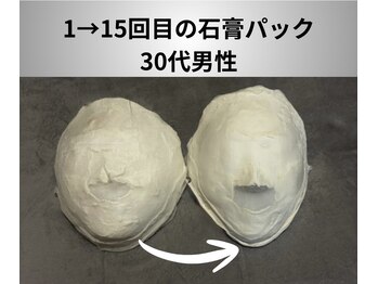 ミピマム 横浜駅前店/15回目の石膏パック/男性