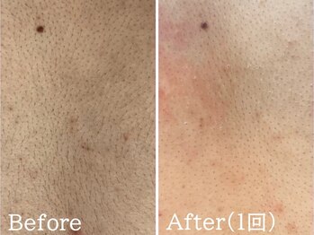 ルナステラ 七尾店/LEDローズ脱毛