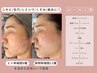 【剥離なし/ 肌質改善/毛穴 】bebeハーブトリートメント◇120分　 ¥33,000