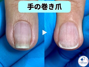 プラスワンフット 本厚木(+1 Foot)/巻き爪矯正は専門店へ●