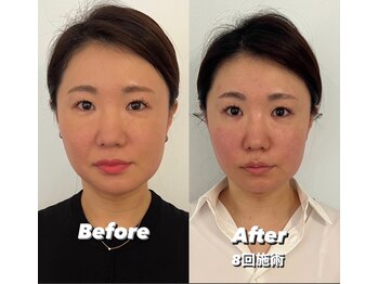 コルミチョン サロン(骨美整 salon)/Before・After 8回施術