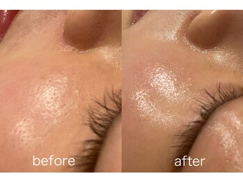 ヴィテラス バイ アリア(Veteras by aria)/☆ハイドラフェイシャル☆