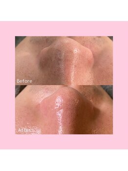 ホワイトラボ 新潟万代(White labo)/【施術例】ハイドロフェイシャル