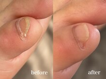 爪のいろは/小指にできる角質、除去できます