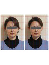 フィシス/顔の歪み左右差のお悩み