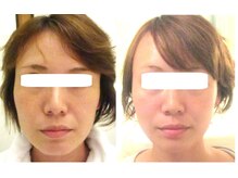 サロンドエステケイワイ(de KY)/フェイシャル☆小顔・タルミ改善