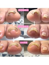 ランランネイル(rangrang nail)/補正後すぐに変化を感じれる