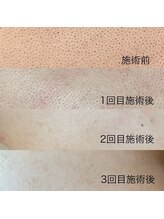 リア(Li'a.)/潤艶WAX脱毛★背中