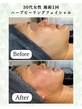 シーフェイス 横浜店(SEE FACE)/30代ハーブピーリングモニター