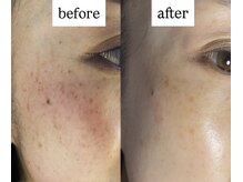 ビー ブルーム(B BLOOM)/【プラズマシミケア】濃淡シミに