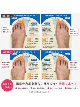 ふみらぼ 亀有/亀有で親指の歪みを改善へ