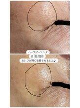 リセリュールサロン 東戸塚(RE:cellulesalon)/ハーブピーリング小じわ改善