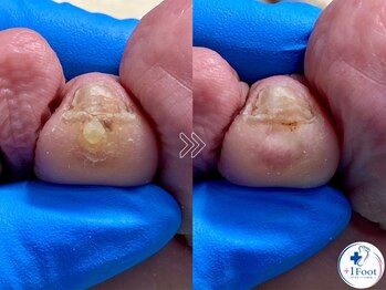 プラスワンフット 本厚木(+1 Foot)/タコ・魚の目ケア！痛みから解放