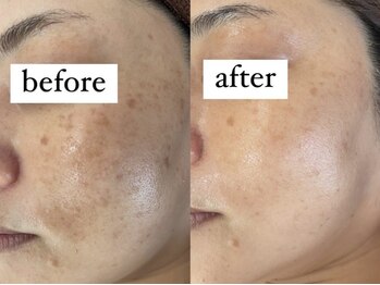 ルヴィ うるま店(REVI)/REVIハーブピーリング