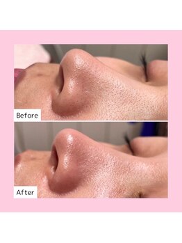 ホワイトラボ 新潟万代(White labo)/【施術例】ハイドロフェイシャル