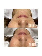 ホワイトワックス 京都四条烏丸(WHITE WAX)/お口周りスッキリ★