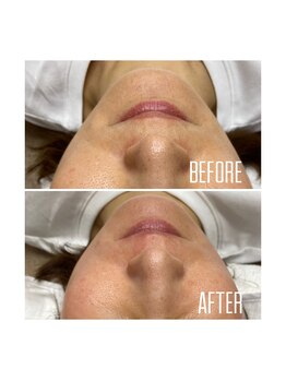 ホワイトワックス 京都四条烏丸(WHITE WAX)/お口周りスッキリ★