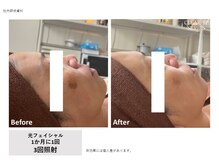 ルミナス 八尾店(Luminous)/光フェイシャル3回目