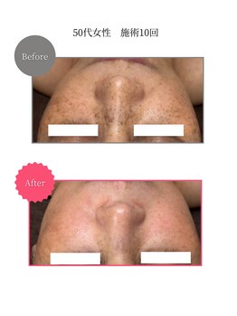 ボータン 恵(Beau Temps)/ウルトラ光トーニング/シミ改善