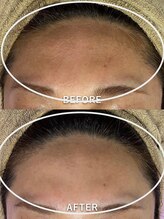 サロンドジェシカ(salon de Jessica)/顔脱毛　おでこ脱毛