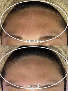 サロンドジェシカ(salon de Jessica)/顔脱毛　おでこ脱毛