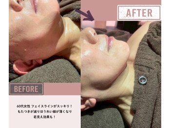 マーリエ(Malie)/【ラフォス】60代リフトアップ顔