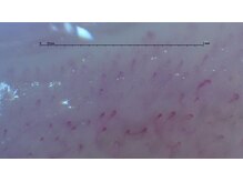 ぷめはな整体/施術後（毛細血管）