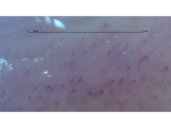 ぷめはな整体/施術後（毛細血管）