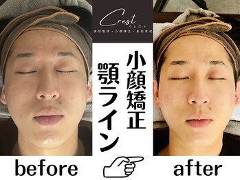 クレスト(CREST)/ビフォーアフター【小顔名古屋】