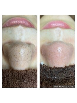 キコ リラクゼーションサロン(KICO by PLUS)/毛穴エクストラクション