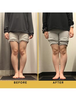 ベル/【20代会員様】O脚矯正の変化