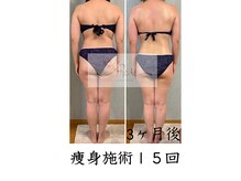 アイ エステサロン(Ai)/【40代】重たい背中・お尻…