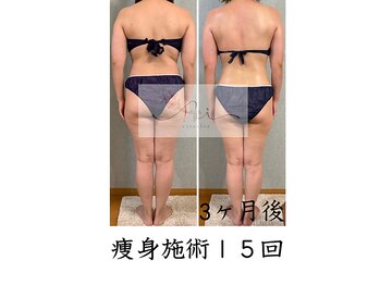 アイ エステサロン(Ai)/【40代】重たい背中・お尻…