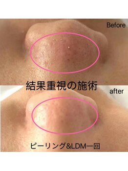 ユミ 町田鶴川店/ピーリング&LDM一回