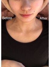リフト 大宮(Lift)/小顔専門店Lift|Before After