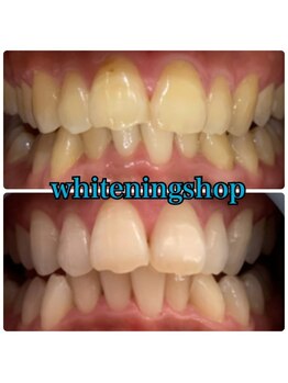 ホワイトニングショップ 池田店/【BEFORE/AFTER】