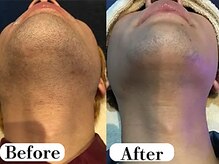 ビースキン 広島(BE:SKIN)/髭/全身脱毛/フェイシャル/VIO