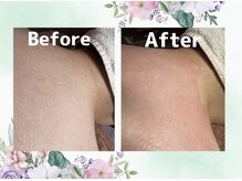 プルート(Pluto)/脱毛　Before/After