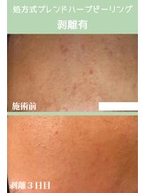 ハーシークレット(Her secret)/ブレンドハーブピーリング３日目