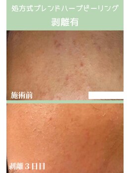 ハーシークレット(Her secret)/ブレンドハーブピーリング３日目