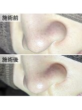 美鼻ラボ 押上 曳舟/お肌は変わる