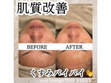 ケア ラウンジ ザ ファースト(THE F1RST)/肌質改善＊ビフォーアフター