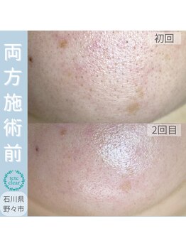 アズール(AZUL)/鼻だけじゃない！