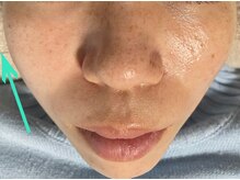 エステティックセラピー プレマ(PREMA)/初回の小顔効果！