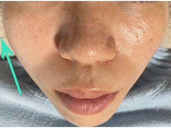 エステティックセラピー プレマ(PREMA)/初回の小顔効果！