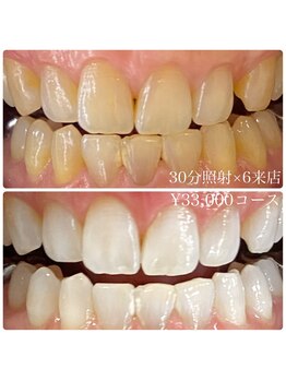 ホワイトニングルーム 川崎店(WhiteningRoom)/ホワイトニング/川崎