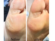 ジュリス(JURIS)/角質ケアコース