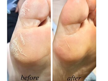 ジュリス(JURIS)/角質ケアコース