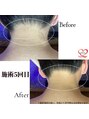 オリオンドットエスツー(Orion.S2) 施術前後比較/うなじ5回目、自分では見えない部分のお手入れ♪