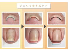 ネルネルネイル(nel nel nail)の雰囲気（巻き爪でお悩みのお客様。巻き爪ケア始めました♪）